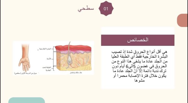 ⁦تقديم الإسعافات الأولية في حالات الحروق⁩ - الصورة ⁦3⁩